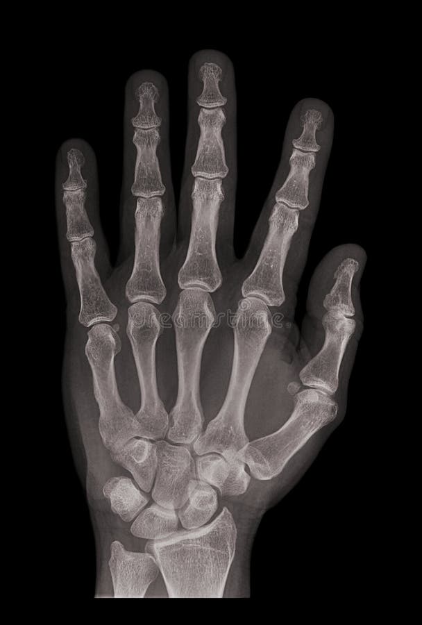 X-xray of a hand on black background. X-xray of a hand on black background
