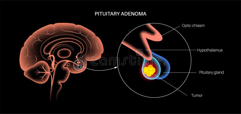 Adenoma hipofisis adalah