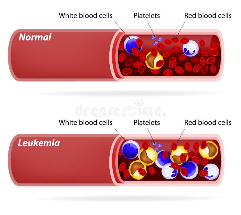 cáncer Leucemia o leucemia ilustración del vector cáncer Leucemia o leucemia ilustración del vector