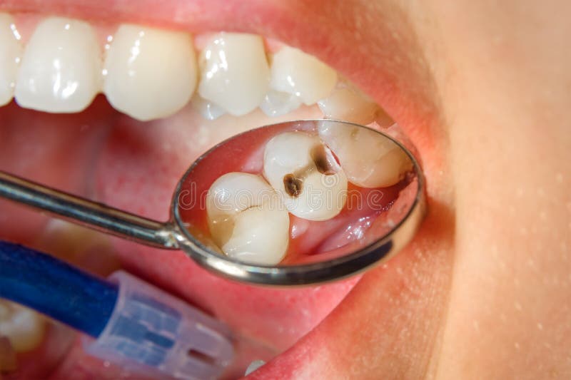 Cárie dental Enchimento com o materi composto dental do photopolymer fotografia de stock Cárie dental Enchimento com o materi composto dental do photopolymer fotografia de stock