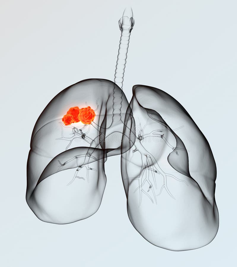Lung cancer on light background, medically 3D illustration showing red tumor. Lung cancer on light background, medically 3D illustration showing red tumor