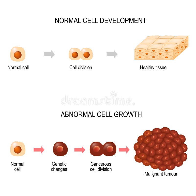 Célula cancerosa ejemplo que muestra el desarrollo de la enfermedad del cáncer ilustración del vector Célula cancerosa ejemplo que muestra el desarrollo de la enfermedad del cáncer ilustración del vector