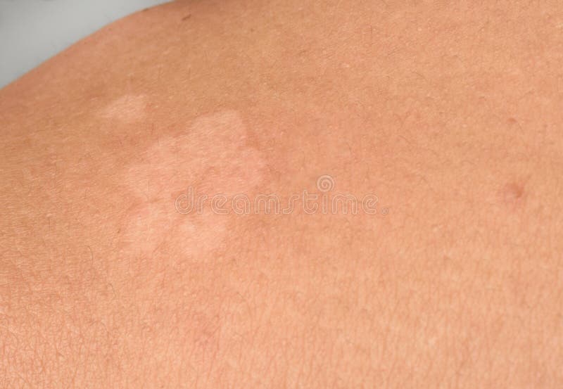 Detail De Champignon De Peau Photo Stock Image Du Dermatite Eruption