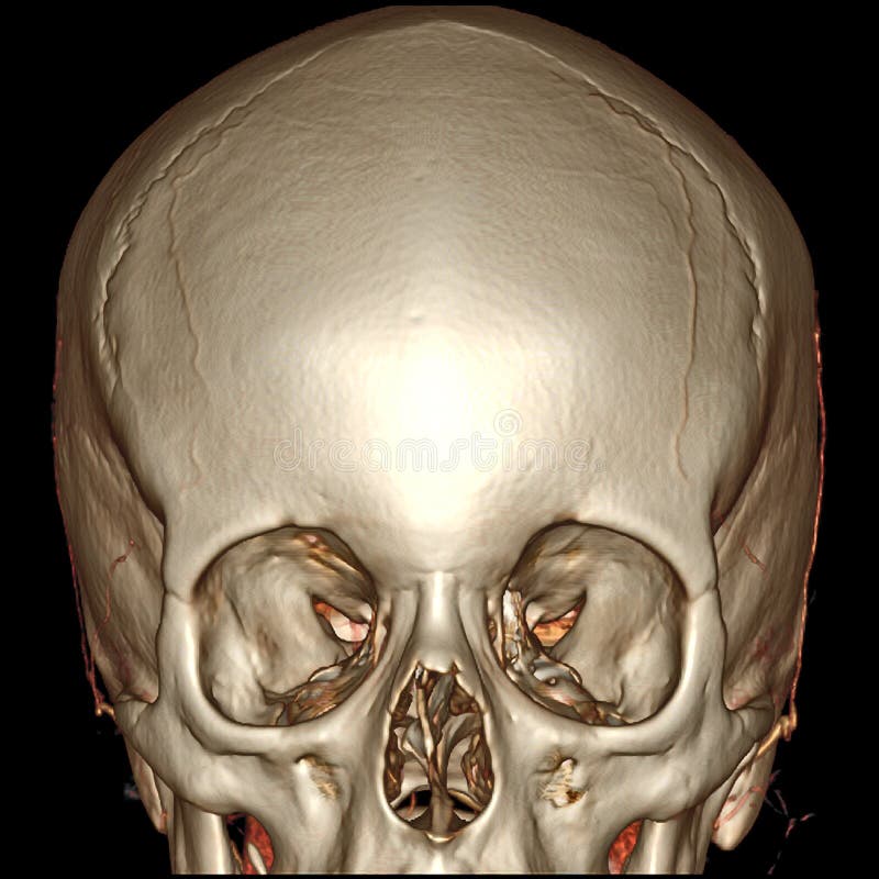 3D CT Brain Front View