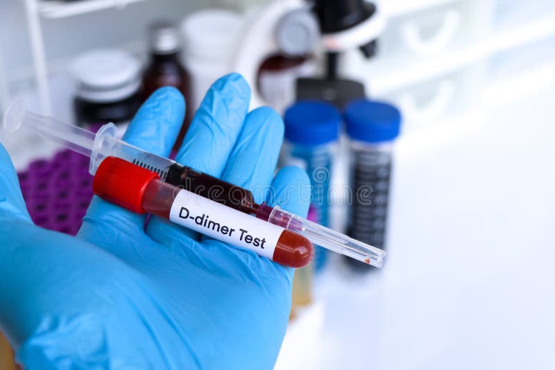 Ddimer Test To Look for Abnormalities from Blood Stock Photo Image