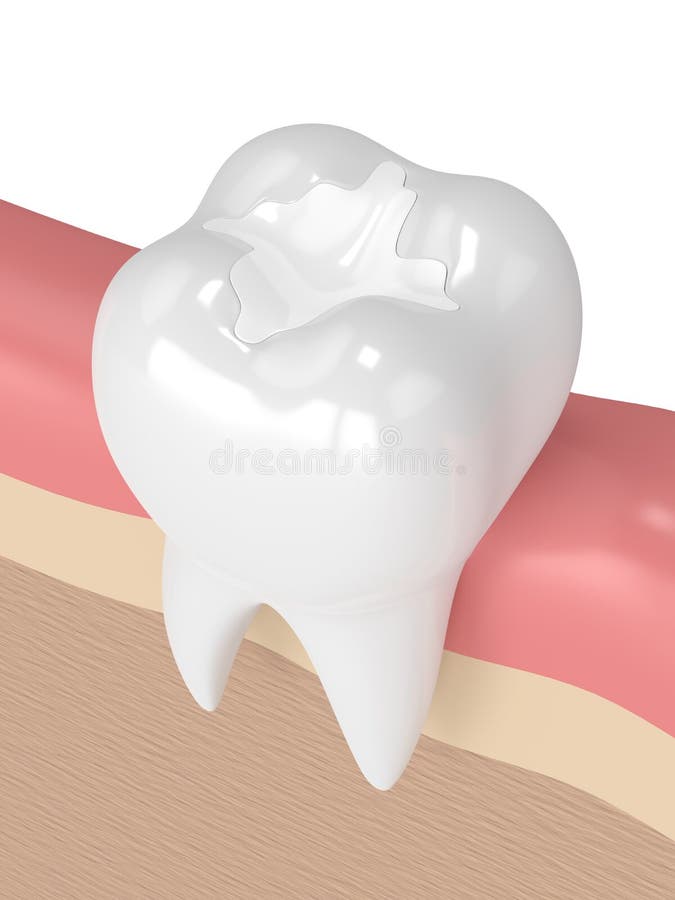 3d geef van tand met het tand samengestelde vullen terug