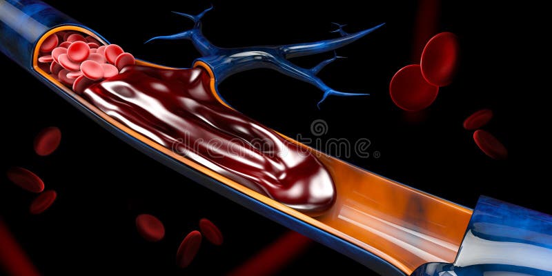 3d Illustration of Deep Vein Thrombosis or Blood Clots. Embolism stock illustration 3d Illustration of Deep Vein Thrombosis or Blood Clots. Embolism stock illustration