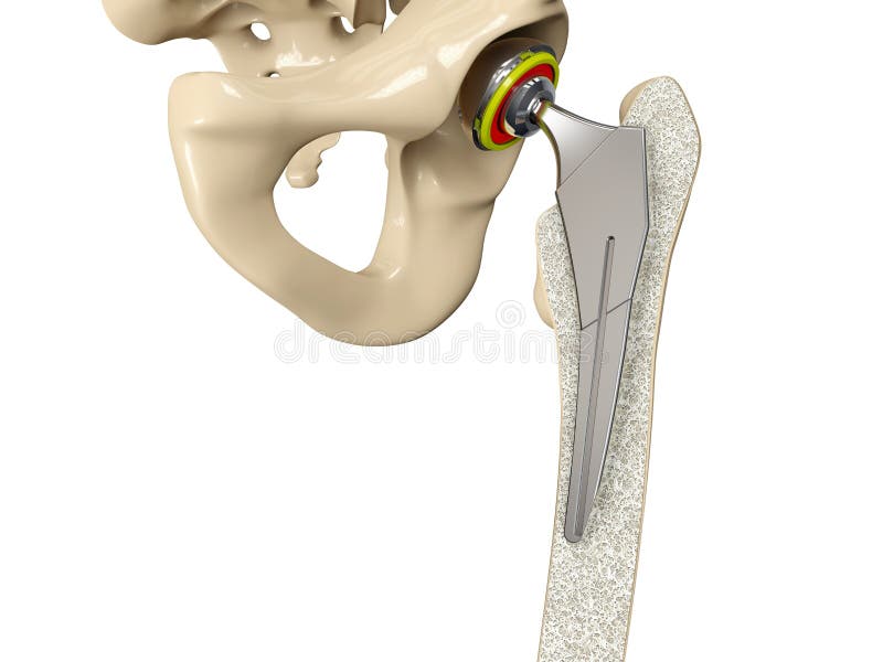 3D illustration of Hip replacement implant installed in the pelvis bone royalty free illustration 3D illustration of Hip replacement implant installed in the pelvis bone royalty free illustration