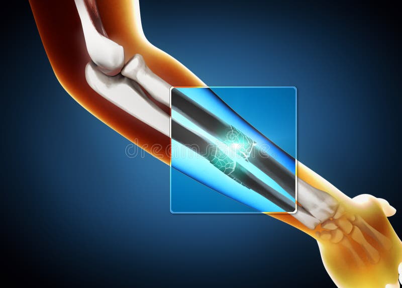 3d illustration of a x-ray image of a broken ulna and radius bone vector illustration