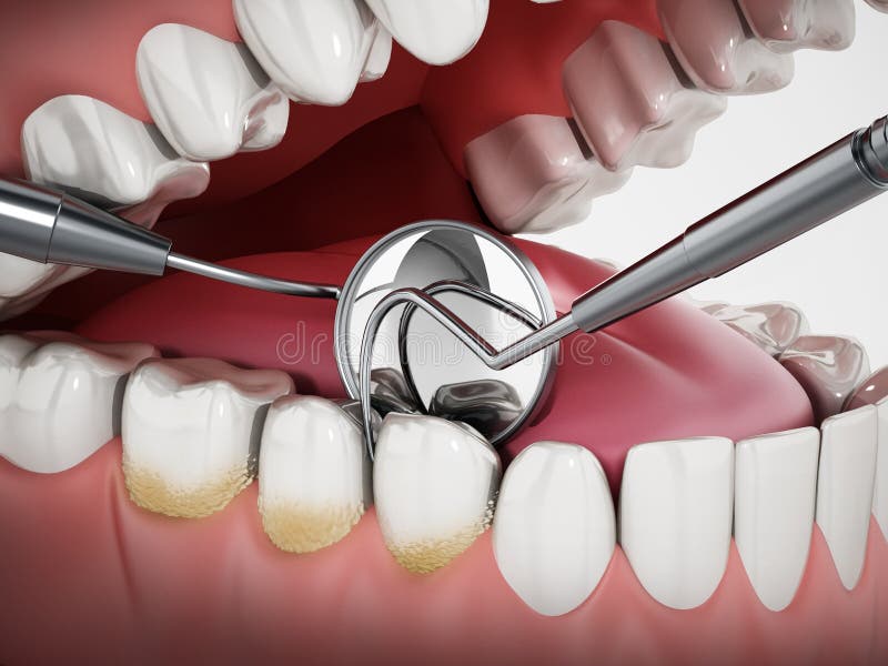 3D Illustration Showing Dentist Tools and Dental Plaque on Model. 3D