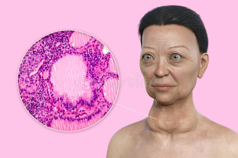 A 3D Illustration of a Woman with Graves Disease Alongside a Micrograph