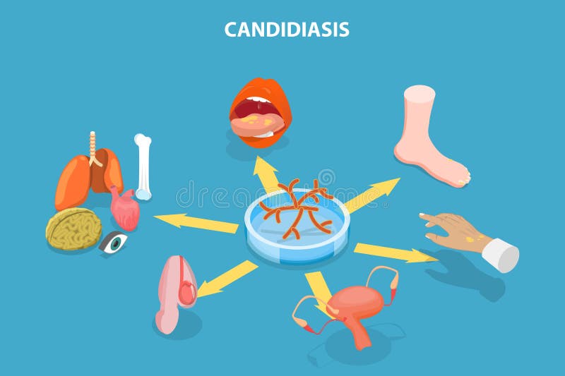 3D Isometric Flat Vector Illustration of Candidiasis Stock Illustration ...