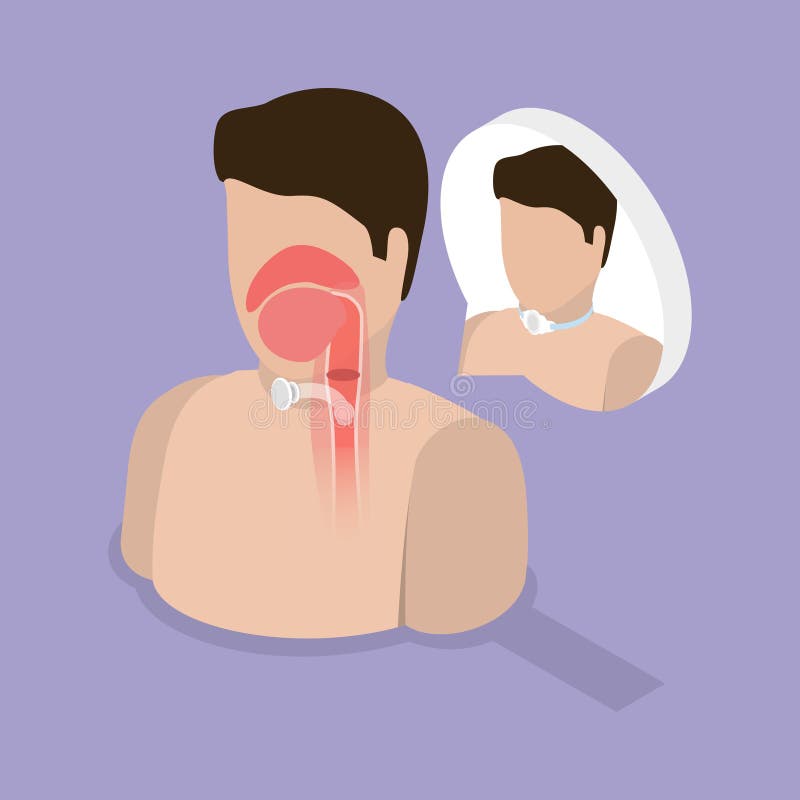 3D Isometric Flat Vector Illustration of Tracheostomy vector illustration