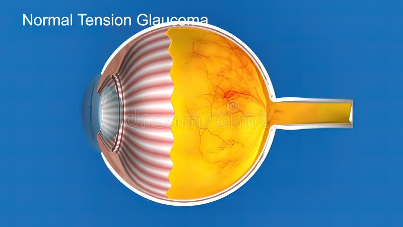 Bệnh tăng cường áp lực mắt thường trên nền xanh: Trải nghiệm vô cùng độc đáo khi xem hình ảnh liên quan đến căn bệnh tăng cường áp lực mắt thường trên nền xanh. Khám phá những giải pháp và thông tin hữu ích để điều trị căn bệnh này một cách hiệu quả.