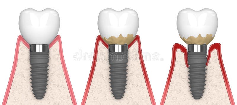 3d render of human gums cross-section with peri implantitis disease process over white background. 3d render of human gums cross-section with peri implantitis disease process over white background