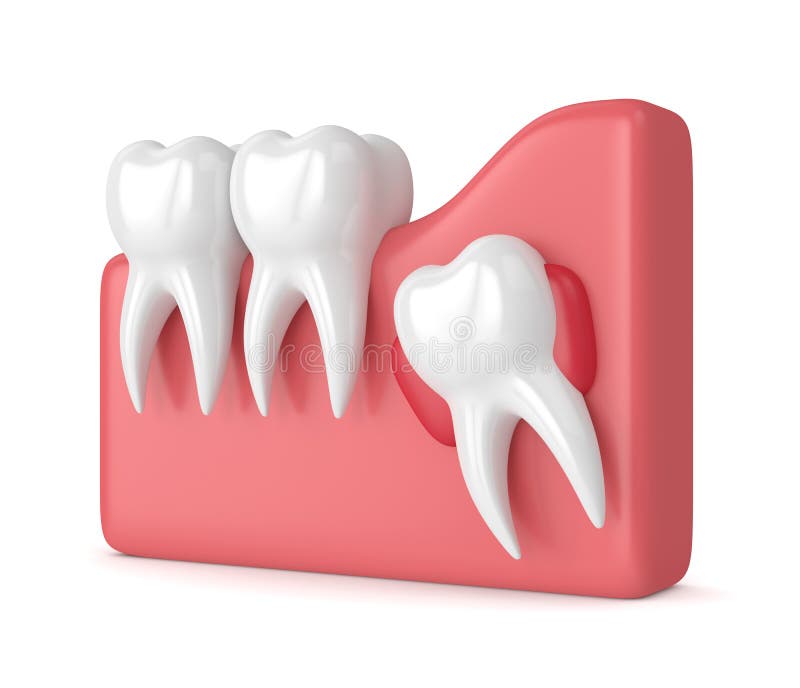 3d rendent des dents avec le kyste de sagesse illustration libre de droits 3d rendent des dents avec le kyste de sagesse illustration libre de droits