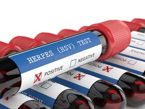 3d Render Of Blood Samples With Herpes Test Stock Illustration Illustration Of Research Phial 3d Render Of Blood Samples With Herpes Test Stock Illustration Illustration Of Research Phial