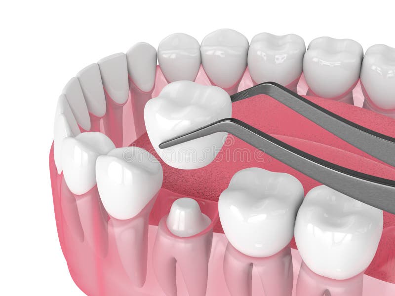 3d Render of Crown Replacement on Reshaped Tooth Stock Illustration