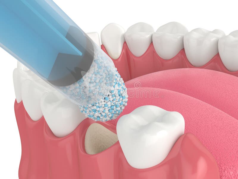 3D Render of Dental Bone Grafting with Dental Bone Biomaterial