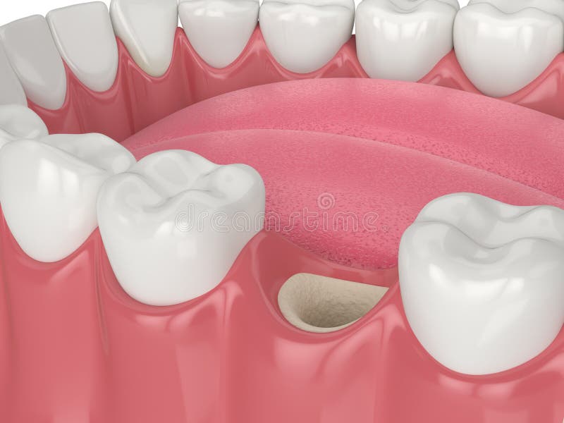 3D Render of Dental Bone Grafting with Bone Biomaterial and Membrane Stock Illustration