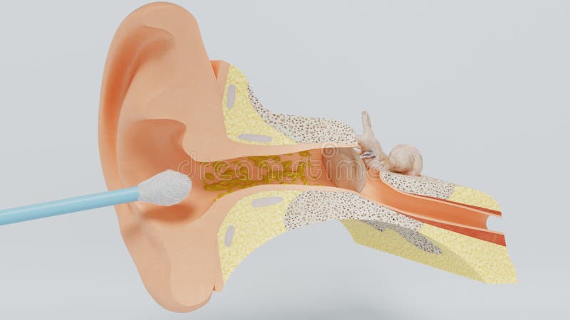 Ear Wax Stock Illustrations – 253 Ear Wax Stock Illustrations, Vectors & Clipart - Dreamstime Ear Wax Stock Illustrations – 253 Ear Wax Stock Illustrations, Vectors & Clipart - Dreamstime