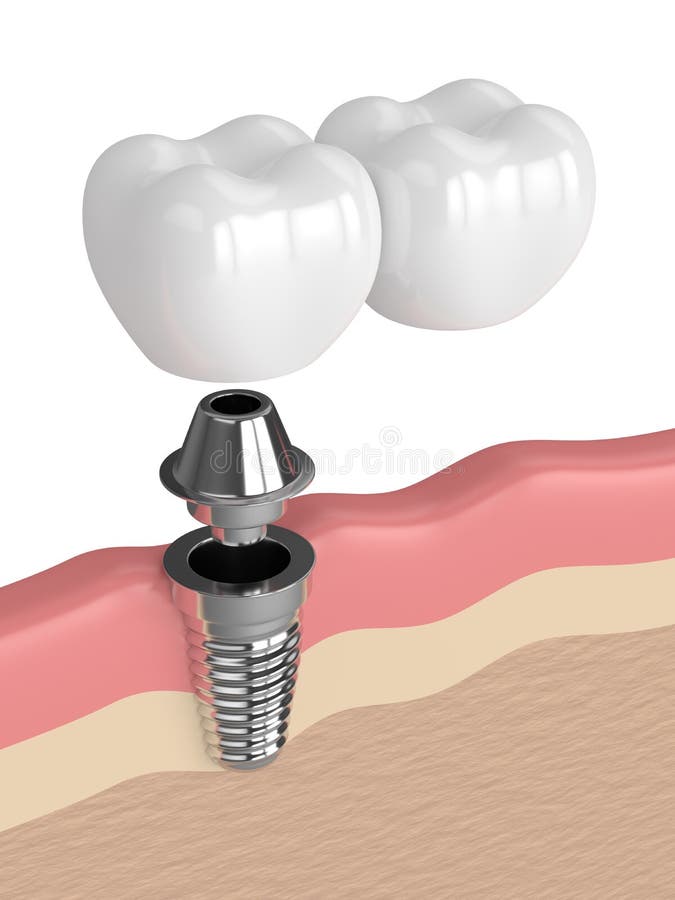 3d Render of Implant with Dental Cantilever Bridge Stock Illustration