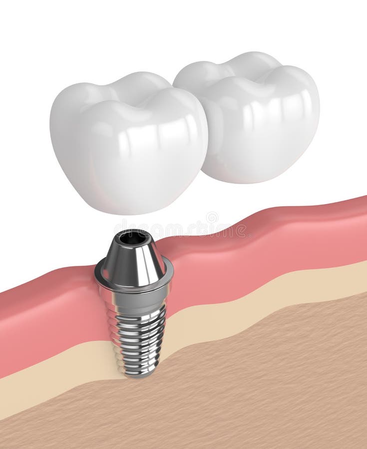 3d Render Of Implant With Dental Cantilever Bridge Stock Illustration Illustration of