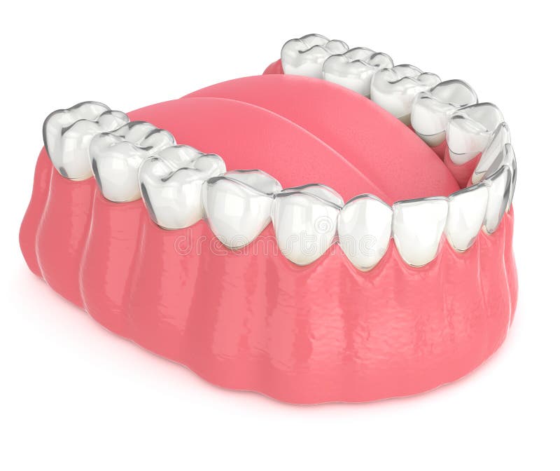 3d render of invisalign removable retainer with lower jaw vector illustration