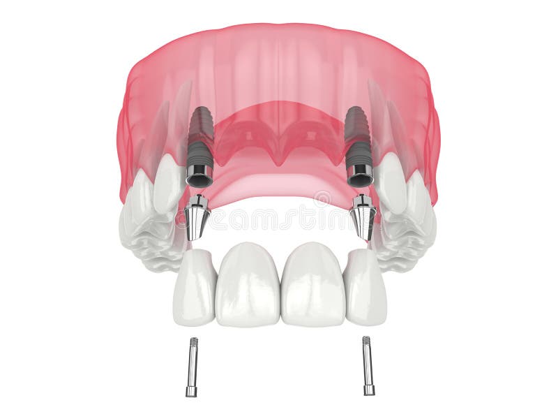 https://thumbs.dreamstime.com/b/d-render-jaw-dental-incisors-bridge-supported-implants-over-white-background-d-render-jaw-de-d-render-jaw-253401352.jpg