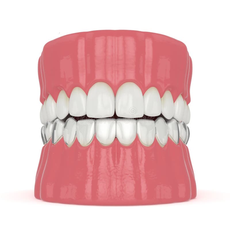 3d render of jaw with invisalign removable retainer stock illustration