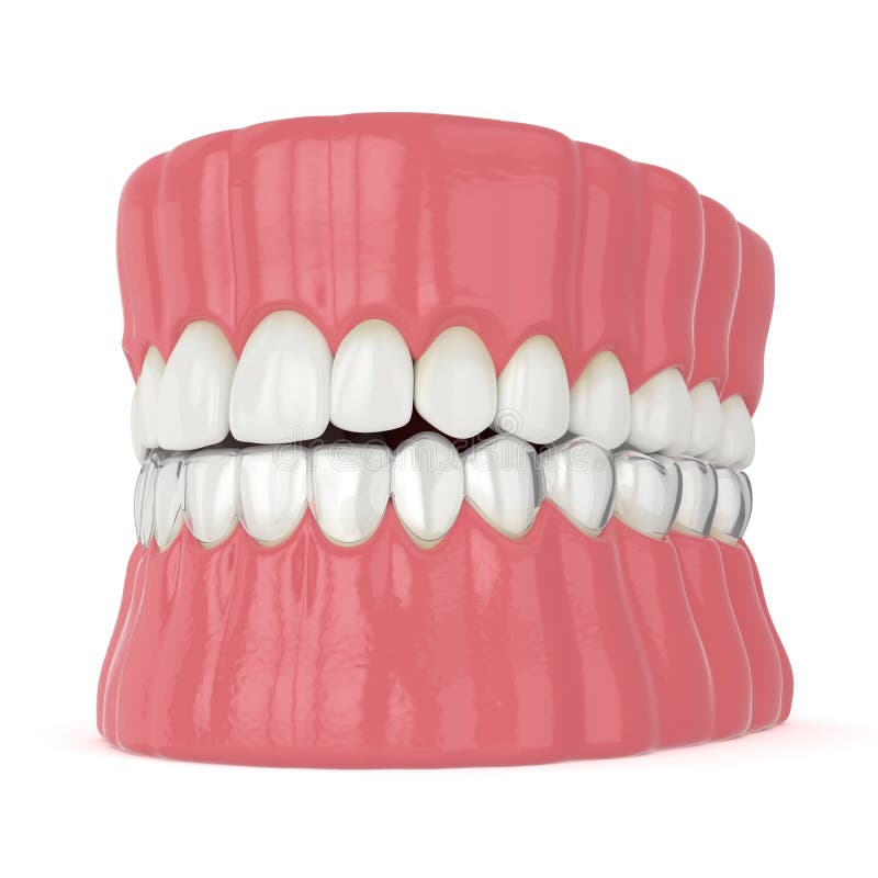 3d render of jaw with invisalign removable retainer vector illustration