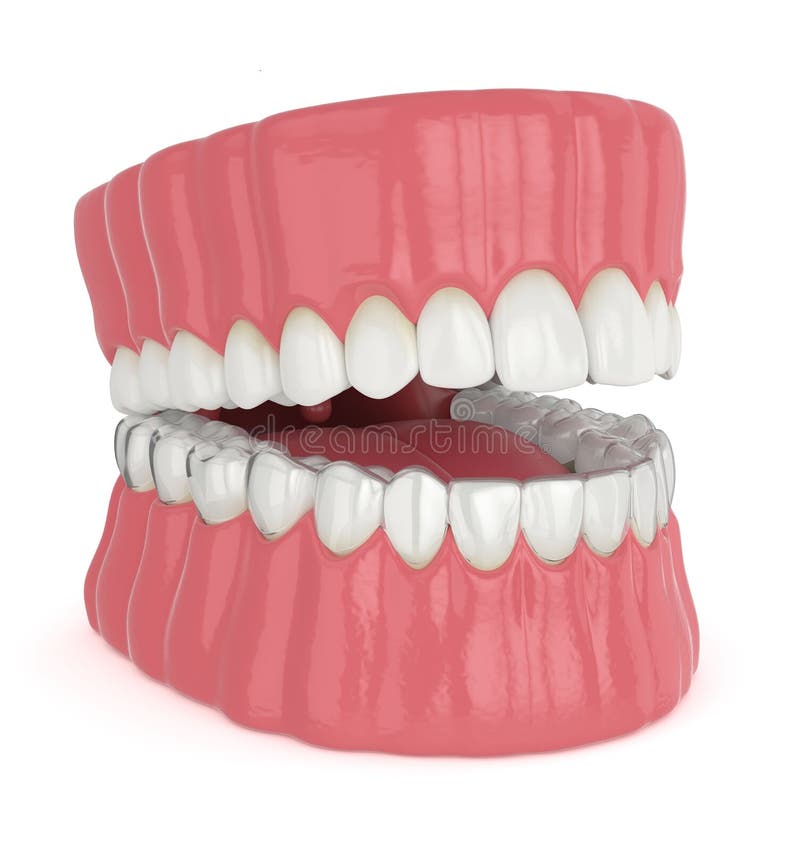 3d render of jaw with invisalign removable retainer royalty free illustration