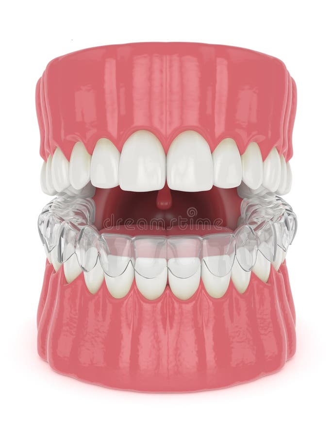 3d render of jaw with invisalign removable retainer royalty free illustration