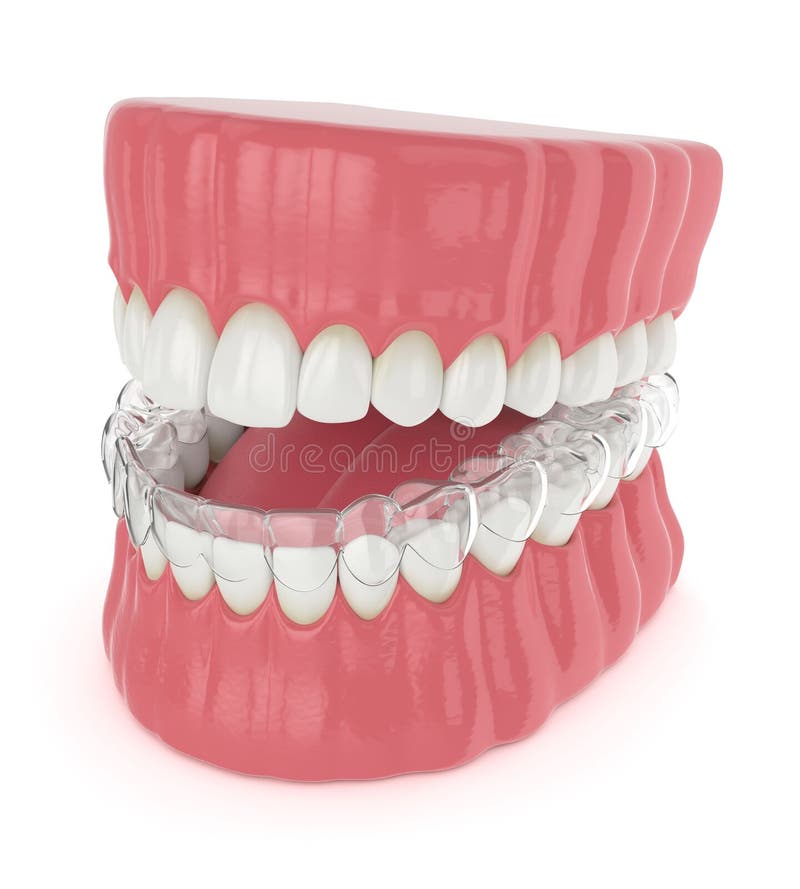 3d render of jaw with invisalign removable retainer vector illustration