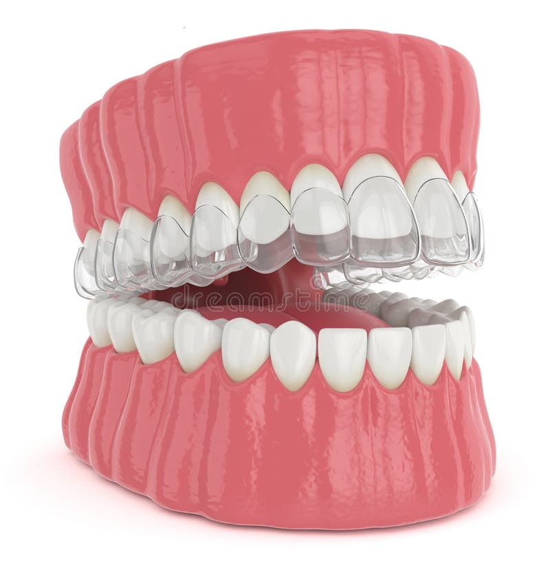 3d render of jaw with invisalign removable retainer stock illustration