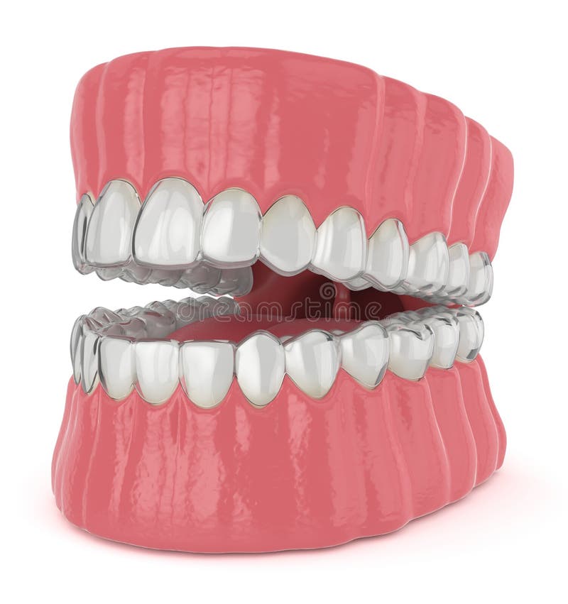 3d render of jaw with invisalign removable retainers stock illustration