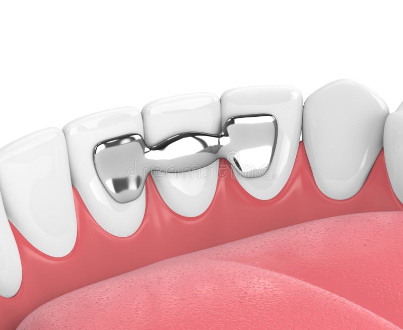 3d Render of Jaw with Teeth and Maryland Bridge Stock Illustration
