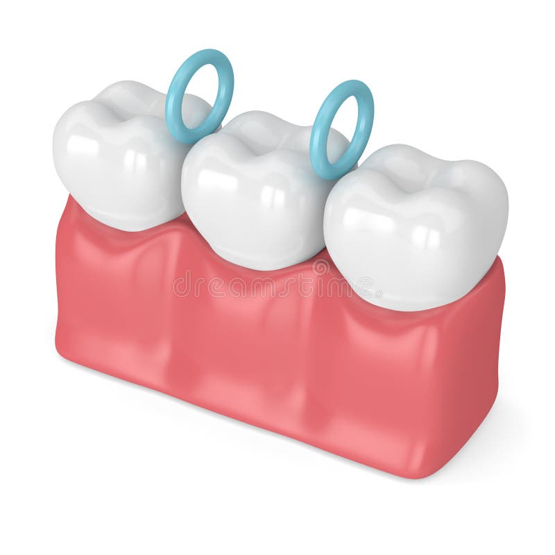 3d Render of Rubber Separators between Teeth Stock Illustration