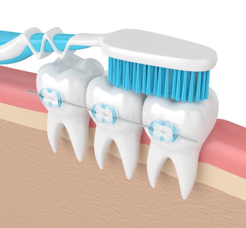 3d Render of Teeth with Braces and Toothbrush Stock Illustration