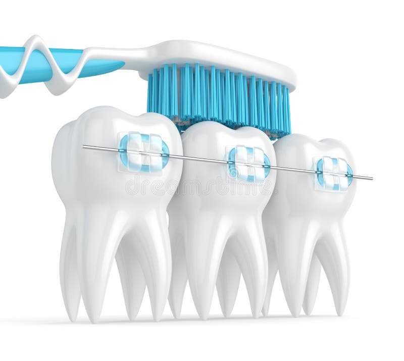 3d Render of Teeth with Braces and Toothbrush Stock Illustration