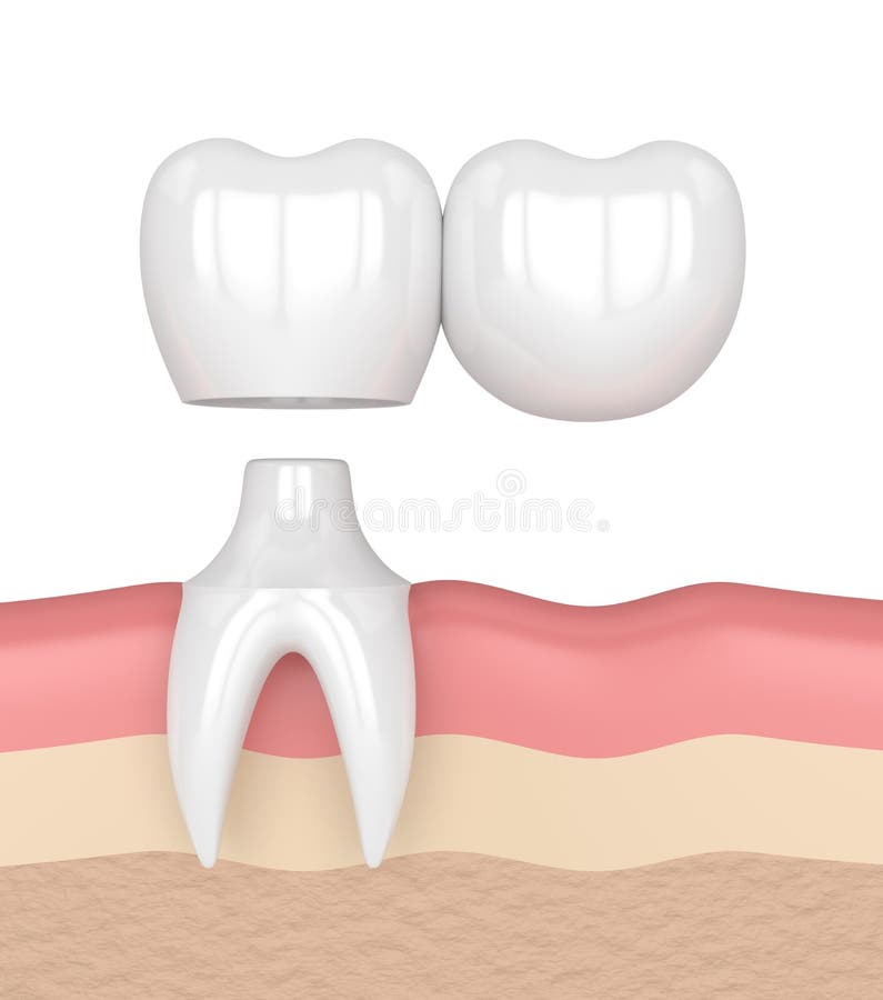 3d Render of Teeth with Dental Cantilever Bridge Stock Illustration