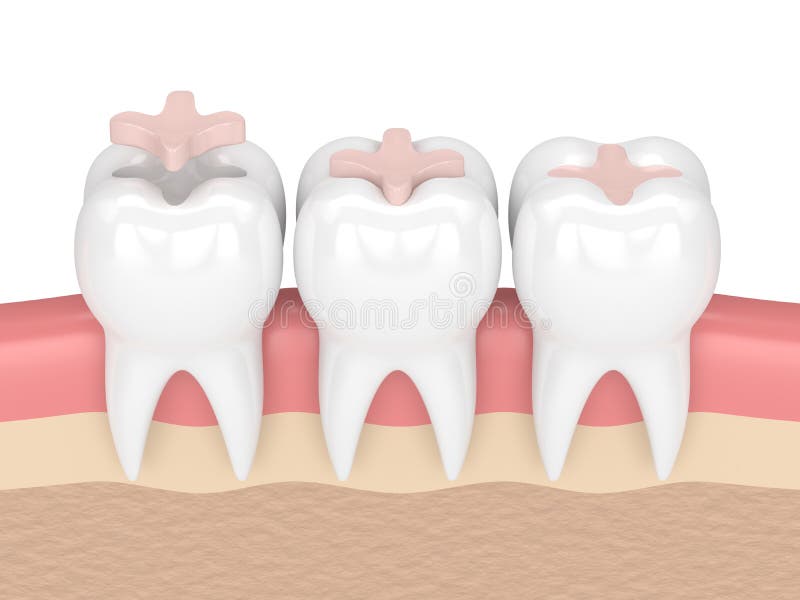 3d render of teeth with dental inlay filling