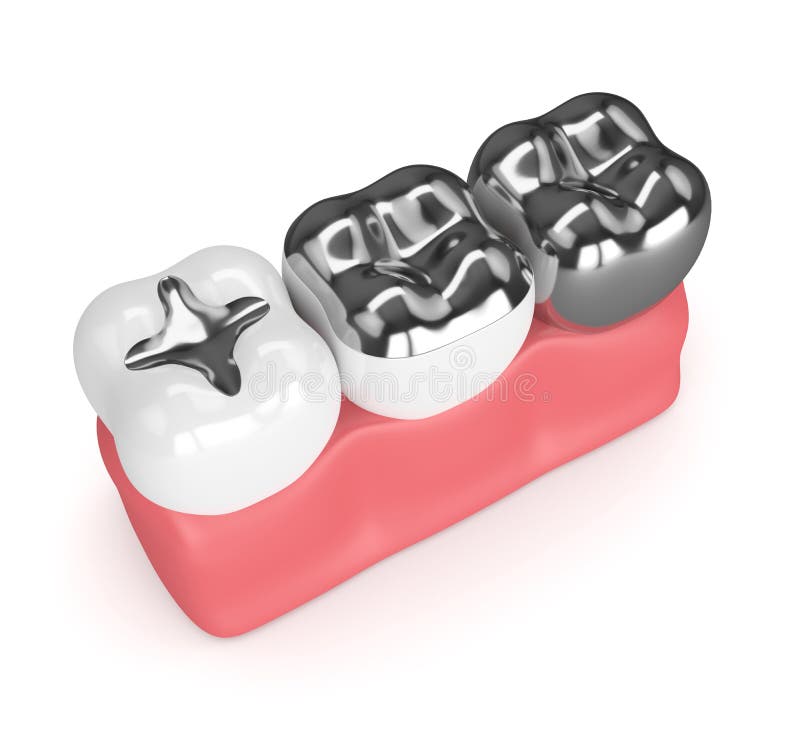 3d Render of Teeth with Different Types of Dental Amalgam Filling Stock