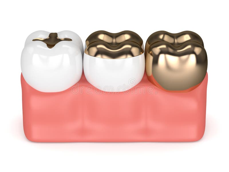 3d Render of Teeth with Different Types of Dental Gold Filling Stock