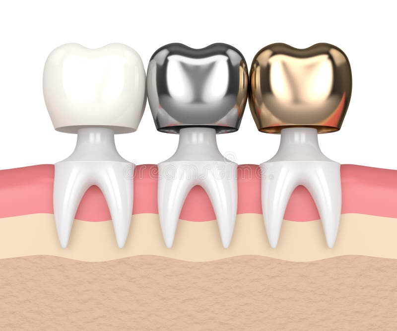 3d Render Of Teeth With Different Types Of Dental Crown Stock