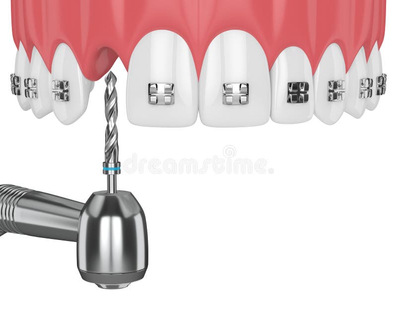 3d Render of Teeth with Orthodontic Braces and Dental Drill Stock Illustration Illustration of
