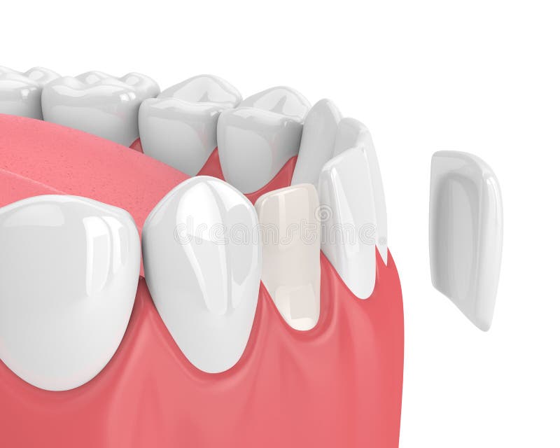 3d render of teeth with veneer stock illustration 3d render of teeth with veneer stock illustration