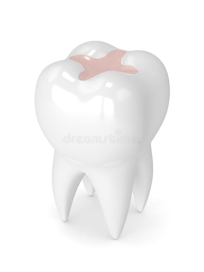 3d render of tooth with dental inlay filling