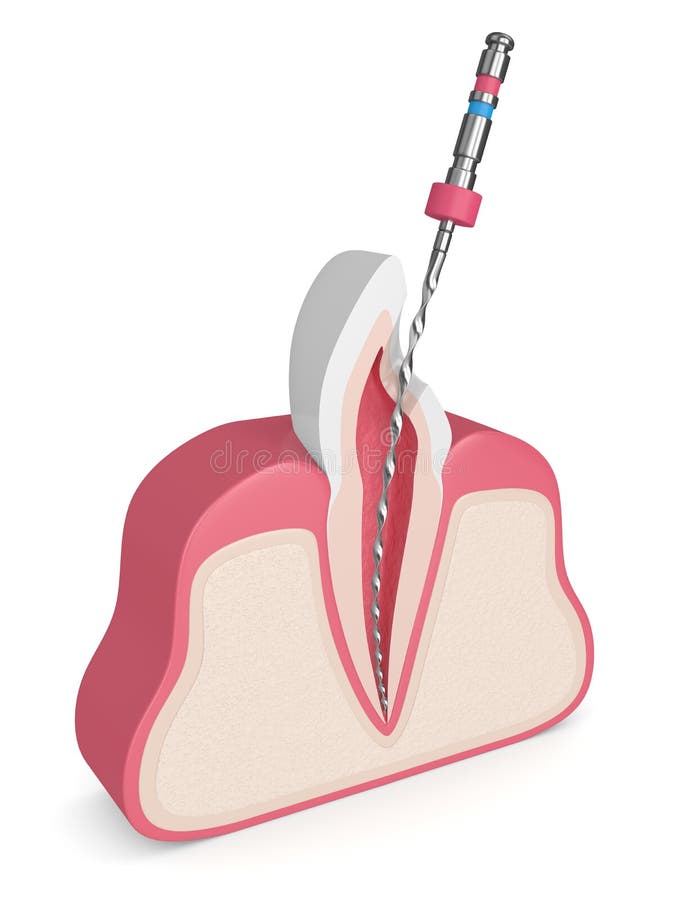 3d Render of Tooth with Endodontic File in Gums Stock Illustration