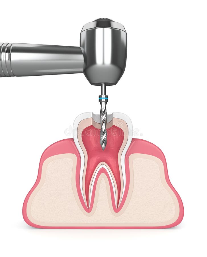 3d Render of Tooth in Gums with Dental Drill Stock Illustration Illustration of crown